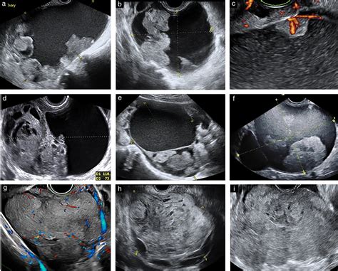 Ovarian Cancer Tumor Ultrasound