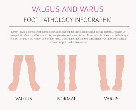 Foot Deformation As Medical Desease Infographic Valgus And Varus Defect ...