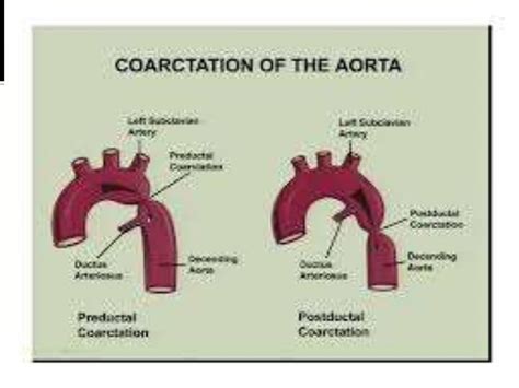 Coarctation of aorta