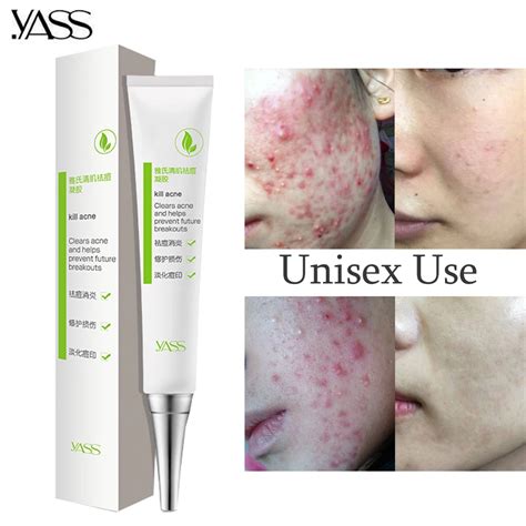 Aliexpress.com : Buy Herbal Acne Cream Anti Pimple Spot Acne Scars ...