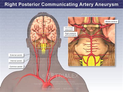 Right Posterior Communicating Artery Aneurysm - TrialQuest Inc.