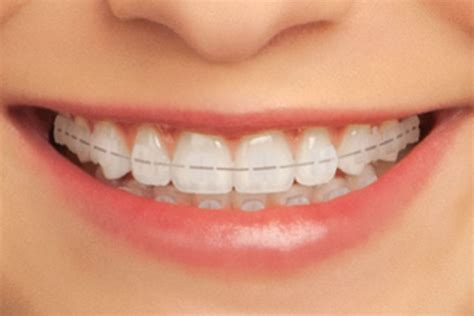 Clear Braces - Teeth & Braces Clinic - Indore