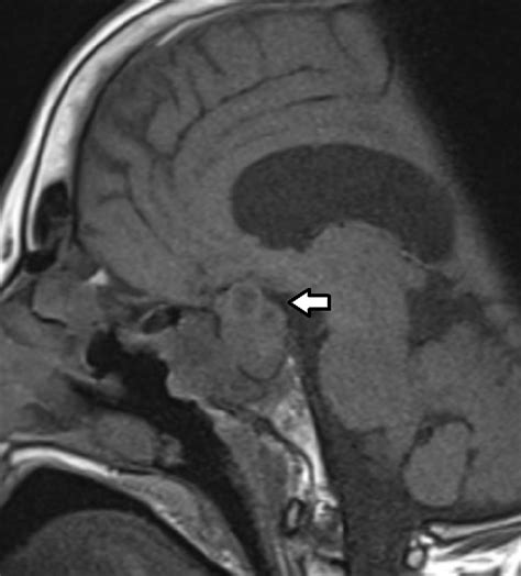 MRI pituitary without contrast showing a pituitary mass, initially ...