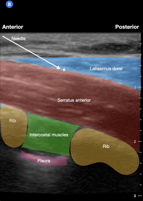 Serratus Anterior Plane Block • LITFL • Nerve Block Library