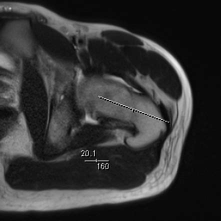 Femoral retroversion | Image | Radiopaedia.org