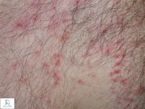 Pruritus(Itching): Symptoms, Causes & Treatment » How To Relief