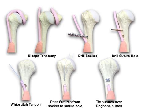 Biceps Tenodesis | The London Shoulder Partnership