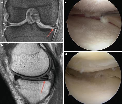 Meniscus Tear MRI Correlation | Radiology Key