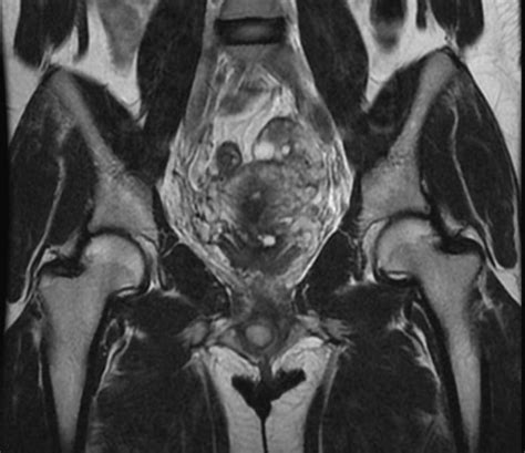 Skene Gland Cyst Diagram