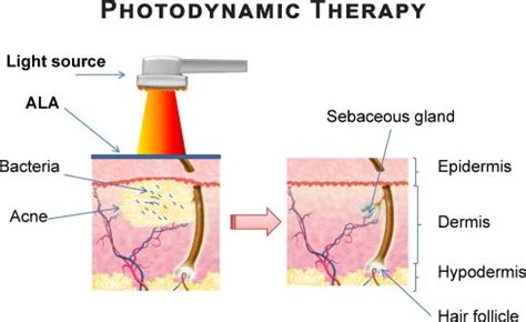 Photodynamic Therapy Specialist · Top Rated Laser Dermatologist in NYC