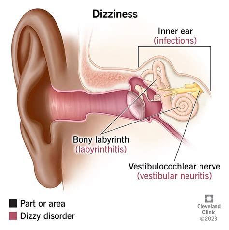 Benign Paroxysmal Positional Vertigo (BPPV): Treatment,