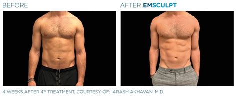 EMSculpt Before and After Abs, Thighs, Arms | Emsculpt Before After ...