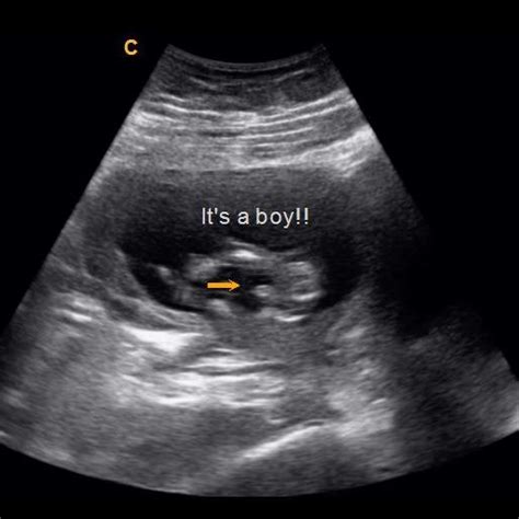 Baby At 14 Weeks Ultrasound Gender - Get More Anythink's