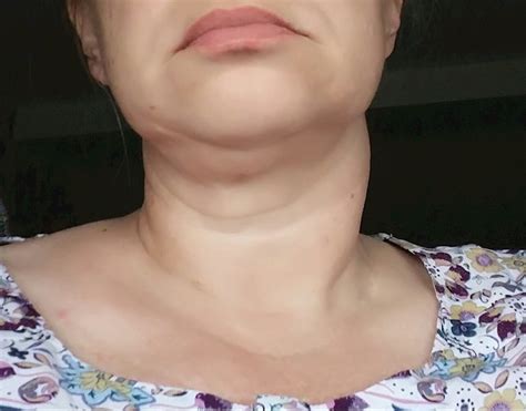 Thyroid Lips Swelling | Sitelip.org