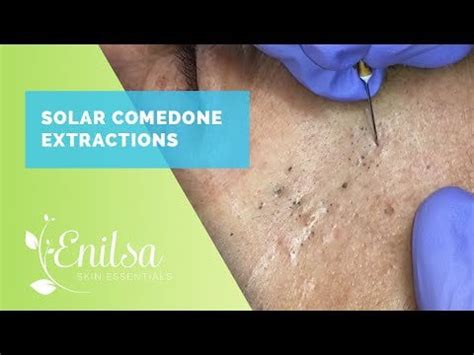 New Enilsa Brown - Solar Comedone Extractions - 22:06 : r/PoppingPimples