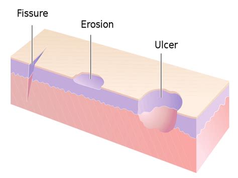 Skin Ulcers & Wound: Causes, Types, Treatment & Symptoms