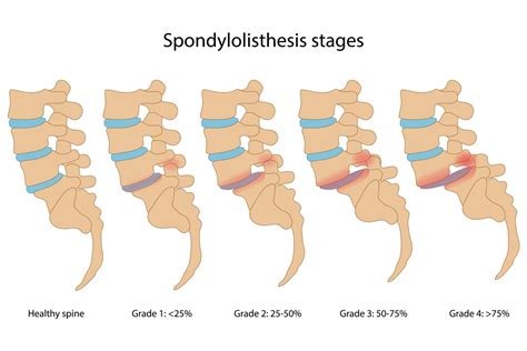 Spondylolisthesis (Degenerative) - Upswing Health | Upswing Health