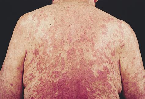 Lichenoid Dermatitis in Paraneoplastic Pemphigus: A Pathogenic Trigger ...