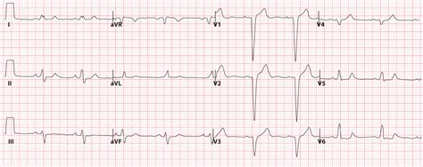 Left Bundle Branch Block Ecg