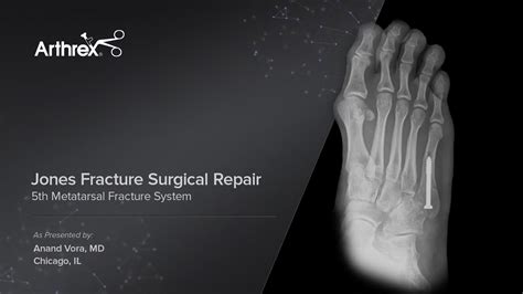 Arthrex - Metatarsal Fracture Repair