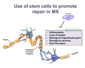 Stem Cell Treatment for Multiple Sclerosis - MS PLS HSCT