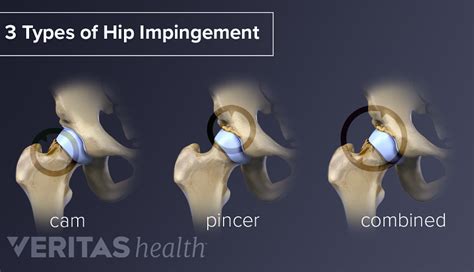 Pain Due to Hip Impingement (Femoroacetabular Impingement) | Sports-health