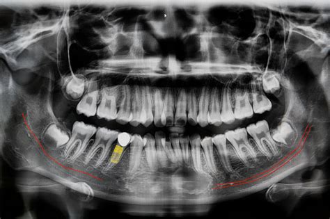 digital-x-ray-of-jaw – Core Dental Specialty Group