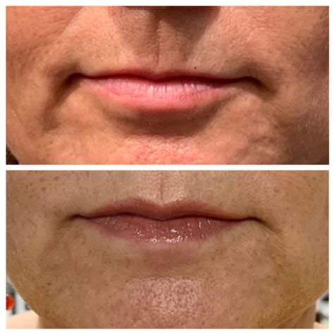 Botox Lip Flip: Everything You Need to Know | Find A Better You