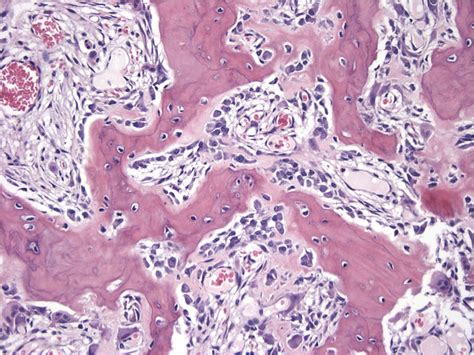 Osteoblastoma Histology