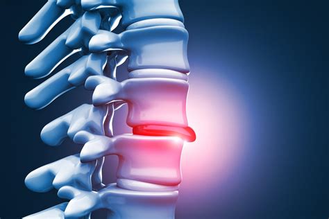 Herniated Disc Specialist - Palm Harbor, FL: Orthopedic Specialists ...