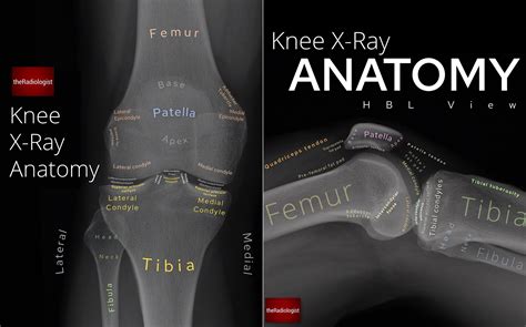 Labeled Hip X-Ray Anatomy By Naveen Sharma TheRadiologist , 43% OFF