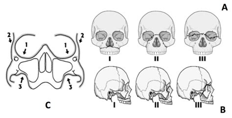 Le fort II fracture: Post workplace head injury - International Journal ...