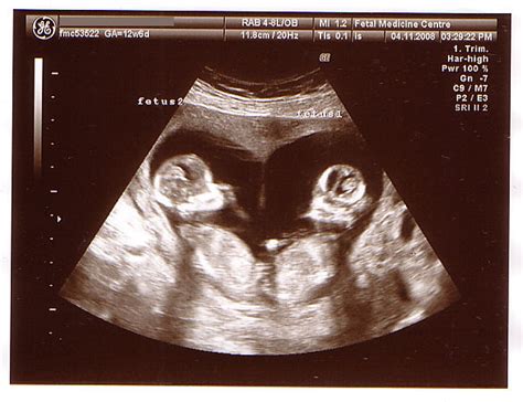 Twins - 12 Week Scan (Heart shaped) | Its official, there's … | Flickr