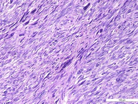 Uterine leiomyosarcoma, routine histological findings: a. fascicles of ...