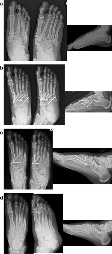 a Anteroposterior, oblique, and lateral injury radiographs of right ...