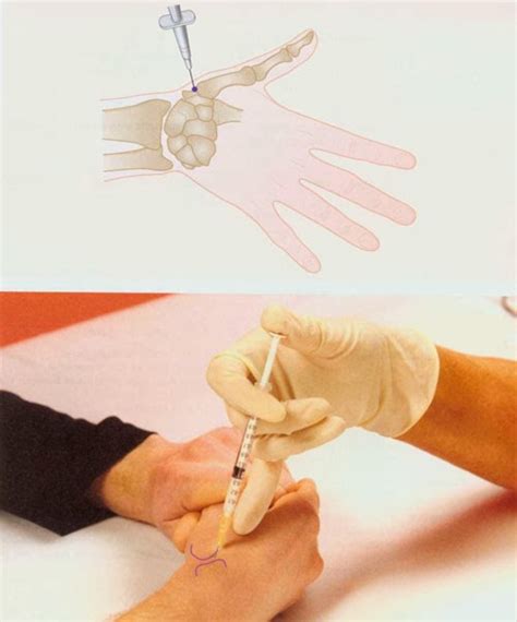 Thumb and Finger Joint Injection ~ Nursing