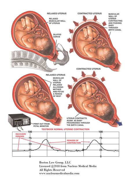 Understanding Uterine Contractions And HIE - HIE Resource Place