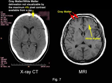 Inventor of the MRI denied the 2003 Nobel Prize in Medicine