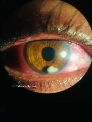 Posterior synechiae - American Academy of Ophthalmology