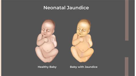 Neonatal Jaundice Symptoms, Causes and Risk Factors in Newborns - VIMS