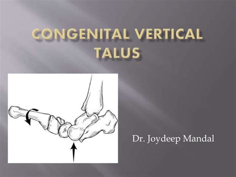 Congenital vertical talus | PPT