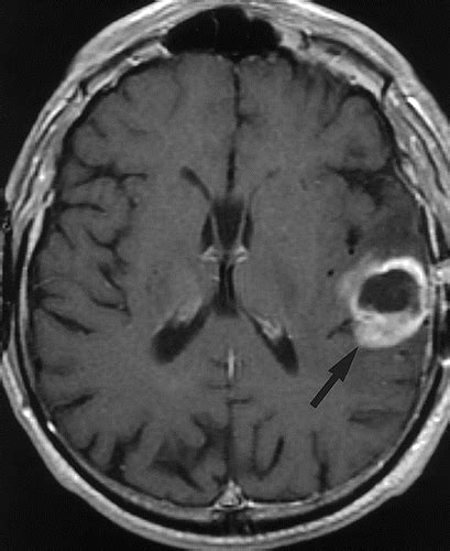 Cat Scan Brain Tumor