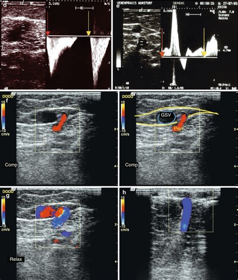 Perforating Veins | SpringerLink