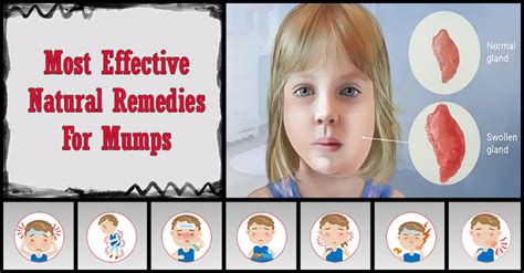 Most Effective Home Remedies For Mumps | Dr Farrah MD