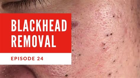 Effective Blackhead Removal Videos: Tips And Techniques For Clear Skin