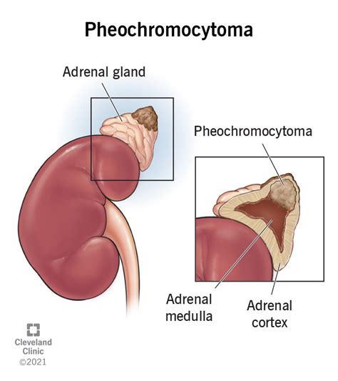 Adrenal Gland Tumor Symptoms