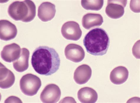 Pesky lymphocytes | Pathology Student