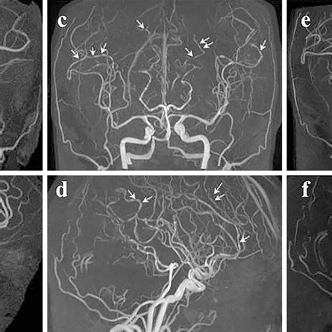 Figure2.a, b: MRA on admission showing no abnormalities. c, d: MRA on ...