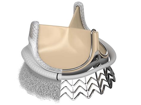 FDA approves Edwards' minimally invasive aortic valve system | Fierce ...