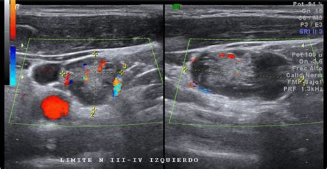 Lymphoma Lymph Nodes Ultrasound